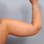 Arm Lift Before & After Patient #790
