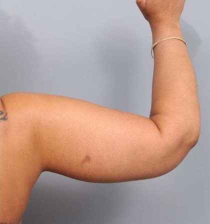 Arm Lift Before & After Patient #790