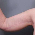 Arm Lift Before & After Patient #807