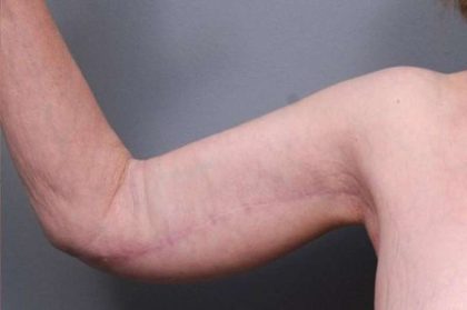 Arm Lift Before & After Patient #807