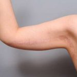 Arm Lift Before & After Patient #814