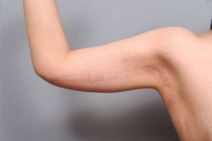 Arm Lift Before & After Patient #814