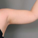 Arm Liposuction Before & After Patient #826