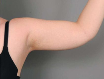 Arm Liposuction Before & After Patient #826