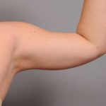 Arm Liposuction Before & After Patient #842