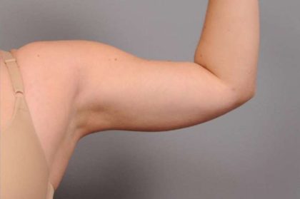 Arm Liposuction Before & After Patient #842