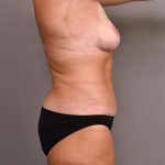Tummy Tuck Before & After Patient #280
