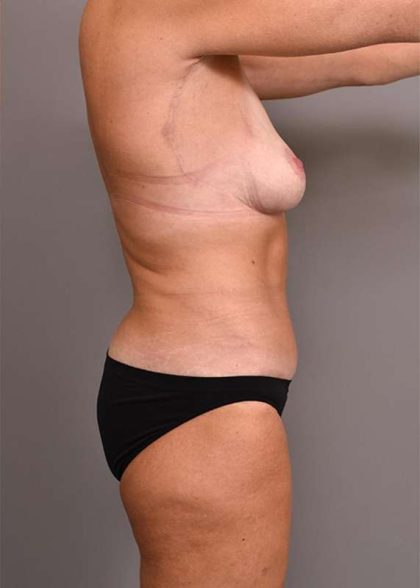 Tummy Tuck Before & After Patient #280