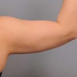 Arm Liposuction Before & After Patient #851