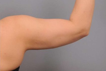 Arm Liposuction Before & After Patient #851