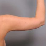 Arm Liposuction Before & After Patient #858