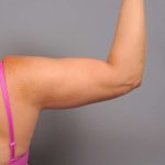Arm Liposuction Before & After Patient #872