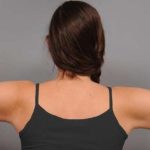 Arm Liposuction Before & After Patient #879