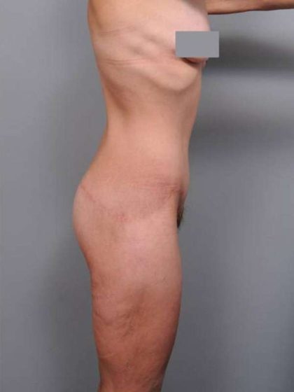 Lower Body Lift Before & After Patient #925