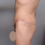 Lower Body Lift Before & After Patient #932