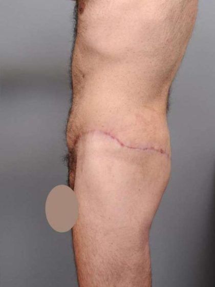 Lower Body Lift Before & After Patient #932