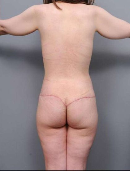 Lower Body Lift Before & After Patient #941