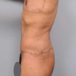 Lower Body Lift Before & After Patient #952