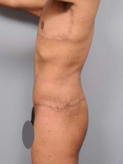Lower Body Lift Before & After Patient #952