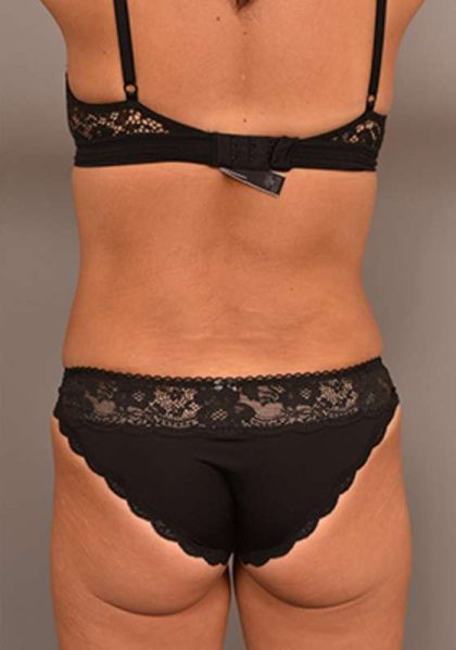 Tummy Tuck Before & After Patient #287