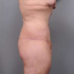 Lower Body Lift Before & After Patient #985
