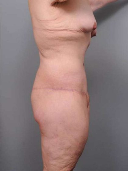 Lower Body Lift Before & After Patient #985