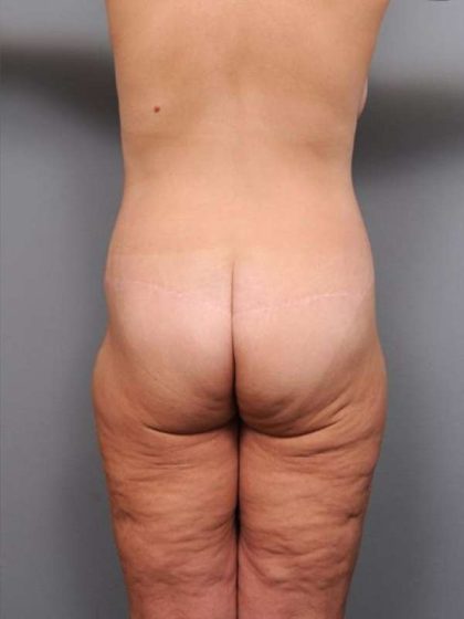 Lower Body Lift Before & After Patient #992