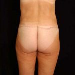 Lower Body Lift Before & After Patient #999