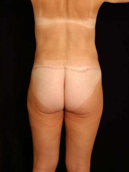 Lower Body Lift Before & After Patient #999