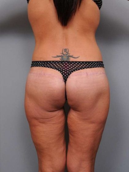 Lower Body Lift Before & After Patient #1010