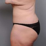 Lower Body Lift Before & After Patient #1027
