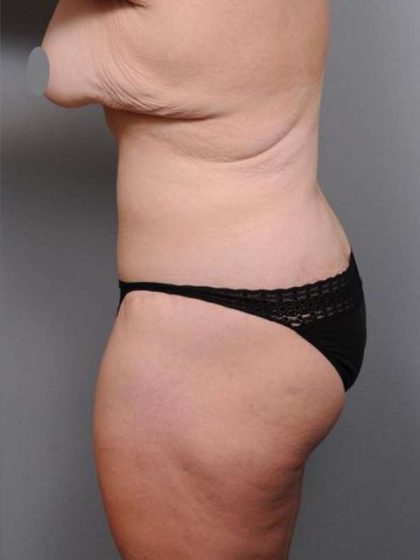 Lower Body Lift Before & After Patient #1027