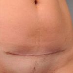 Scar Revision Before & After Patient #1071