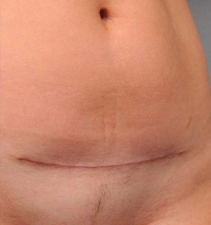Scar Revision Before & After Patient #1071