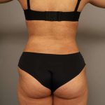 Scarless Rib Contouring (RibXcar) Before & After Patient #1103