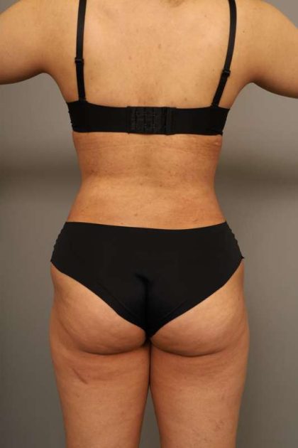 Scarless Rib Contouring (RibXcar) Before & After Patient #1103