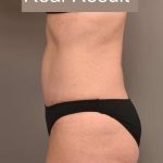 Tummy Tuck Before & After Patient #296