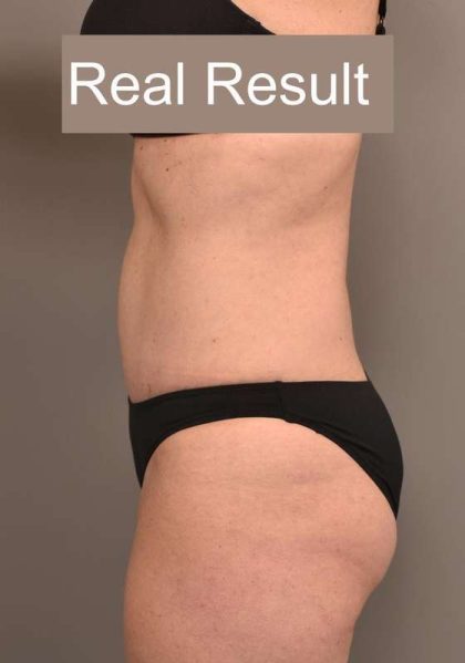 Tummy Tuck Before & After Patient #296