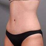 Tummy Tuck Before & After Patient #411
