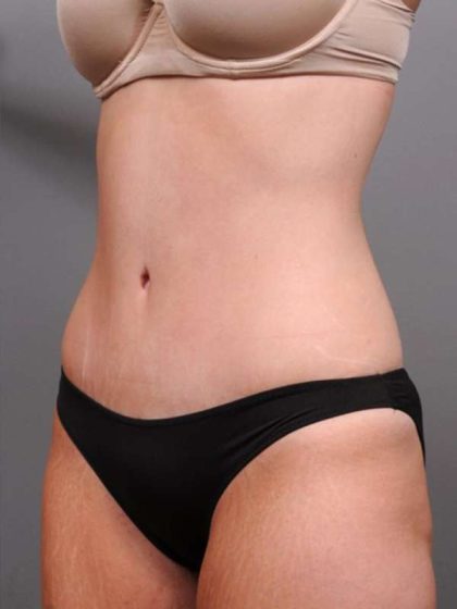 Tummy Tuck Before & After Patient #411