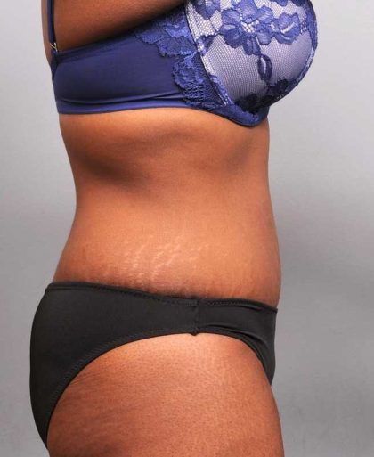 Tummy Tuck Before & After Patient #427