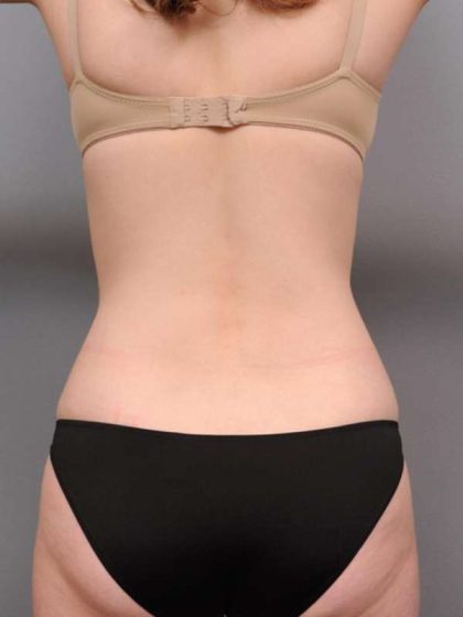 Tummy Tuck Before & After Patient #436