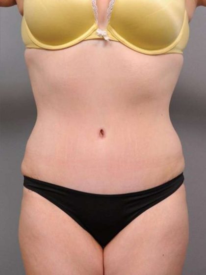 Tummy Tuck Before & After Patient #463