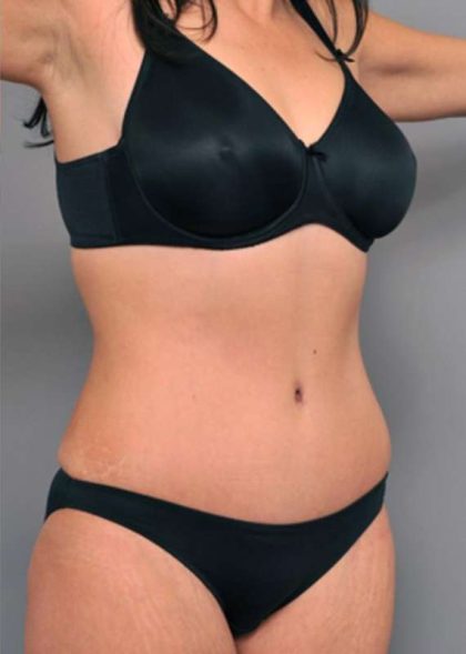 Tummy Tuck Before & After Patient #515
