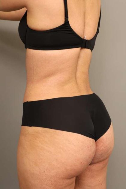 Liposuction Before & After Patient #550