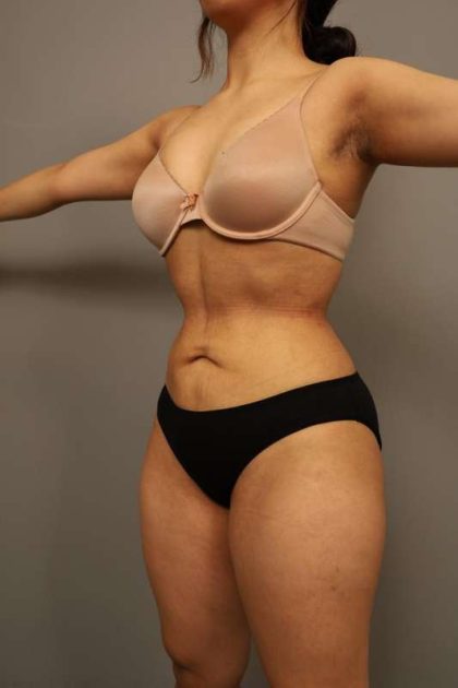 Liposuction Before & After Patient #563