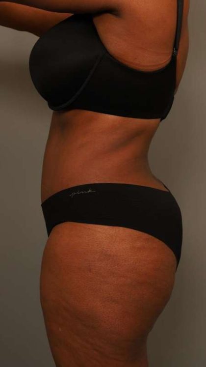 Tummy Tuck Before & After Patient #574