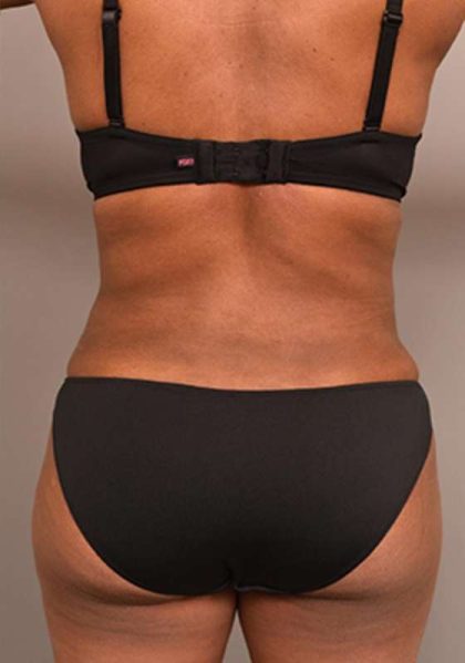 Liposuction Before & After Patient #604