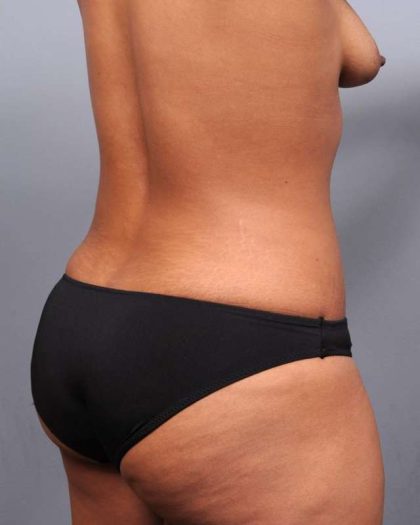 Liposuction Before & After Patient #635