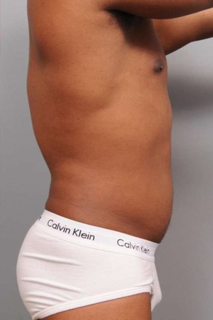 Liposuction Before & After Patient #648